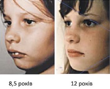 Брекети До та після