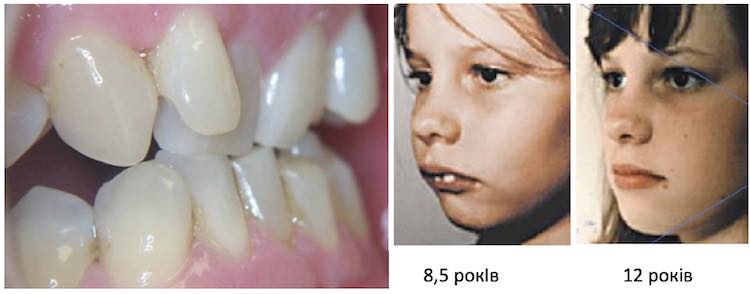 Брекети До і Після