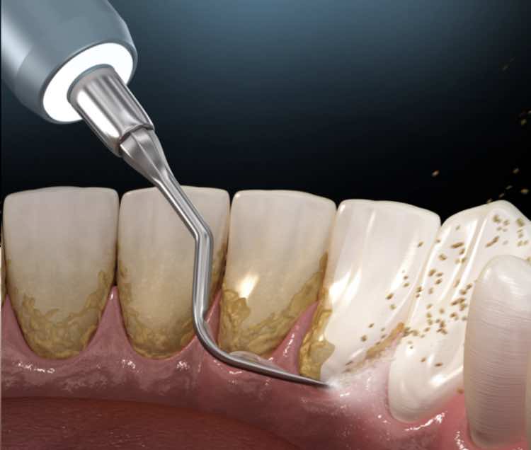 Как снять зубной камень и отложения?