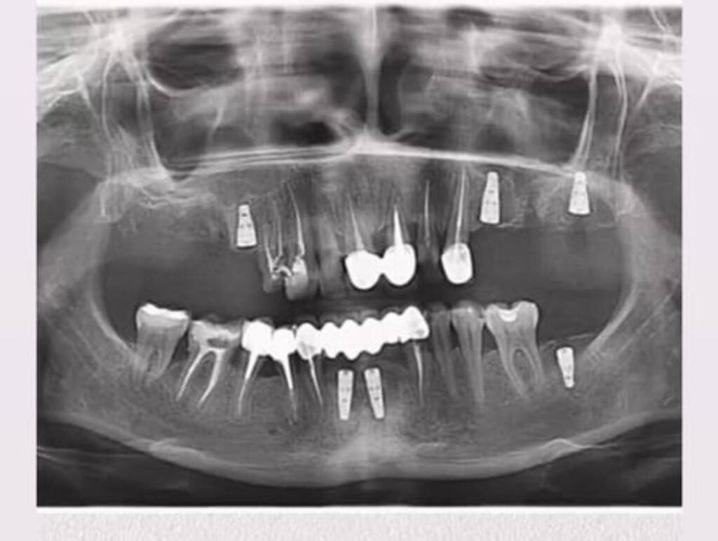 Фото звіт від 2023-04-04: коронки на 6 імплантах DentalKnysh