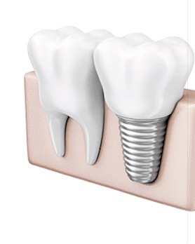 Імплантація зубів ціни