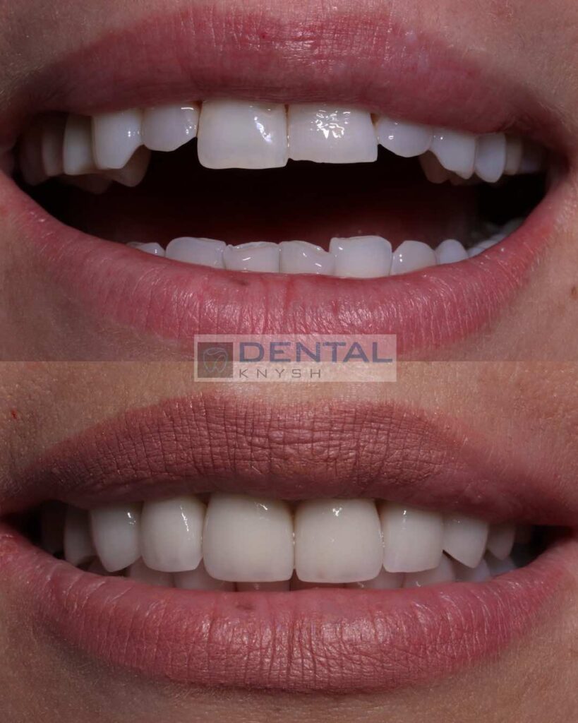 Фото звіт керамічні вініри DentalKnysh 2023-06-25 фото 1