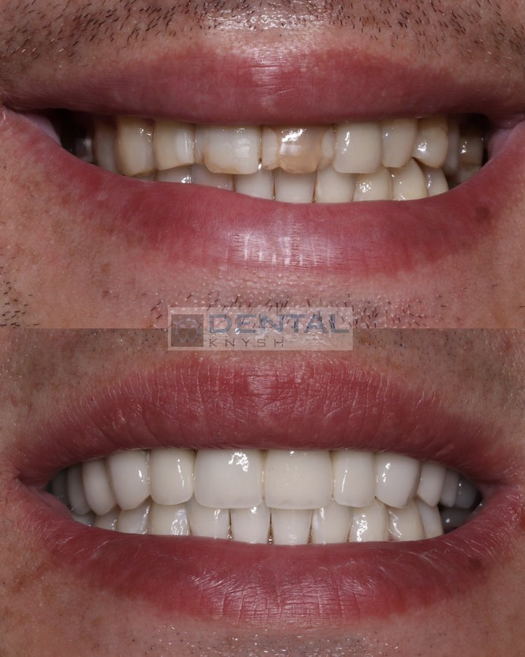 Фото отчет от 2023-07-24

14 коронок на верхних зубах и отбеливание нижних зубов в стоматологической клинике DentalKnysh во Львове на Стуса, 24, фото 2