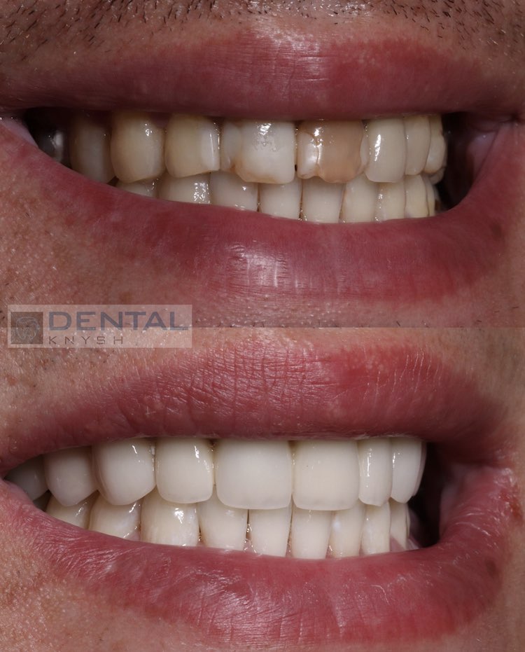 Фото отчет от 2023-07-24

14 коронок на верхних зубах и отбеливание нижних зубов в стоматологической клинике DentalKnysh во Львове на Стуса, 24, фото 1