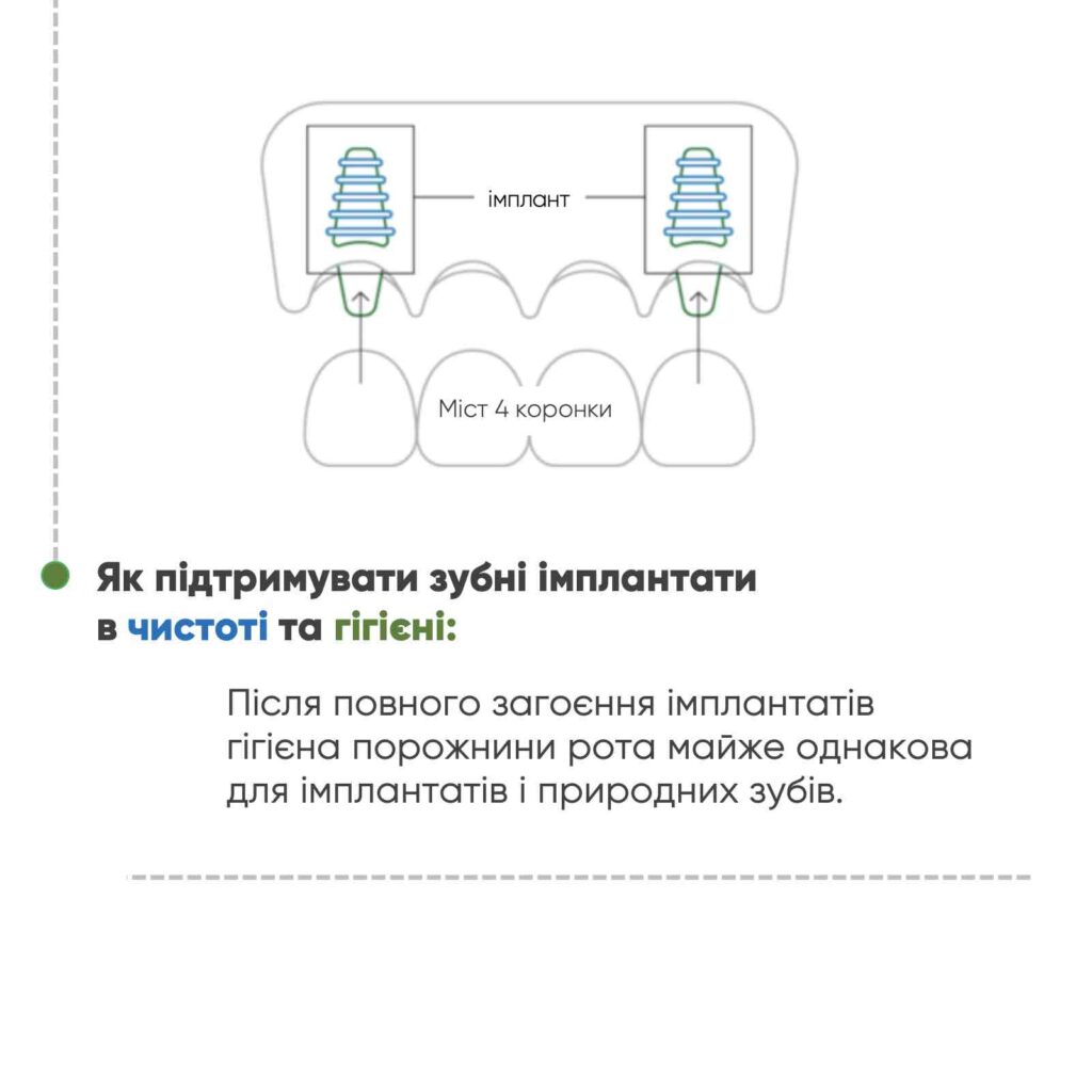 Як чистити зубні імпланти 4 фото