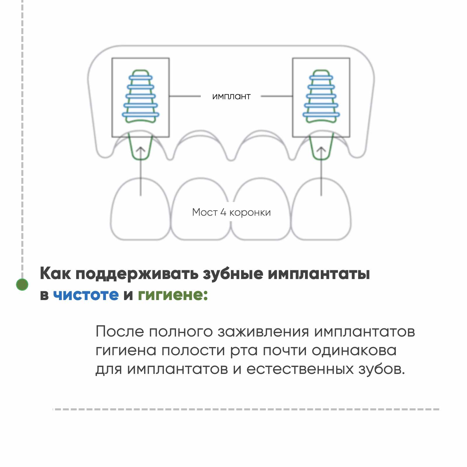 Как чистить зубные импланты, краткое руководство, стр 4
