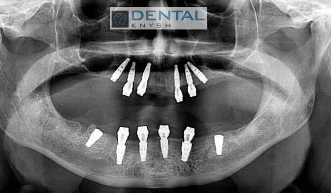 2023-09-05-скан-кт-12-імплантів-DentalKnysh