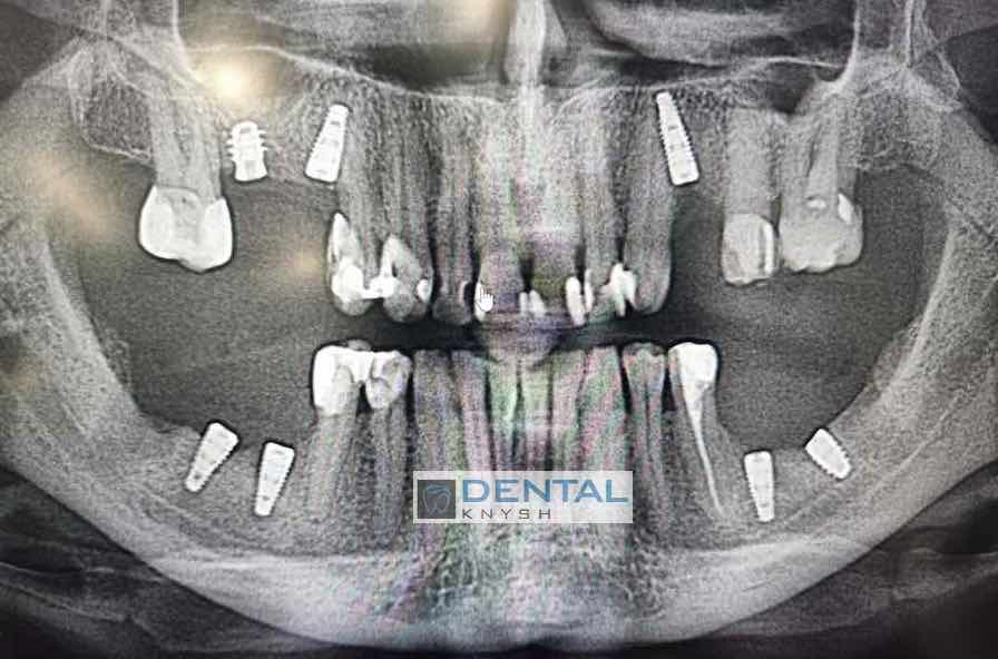 2023-09-06-скан-кт-6-імплантів-DentalKnysh