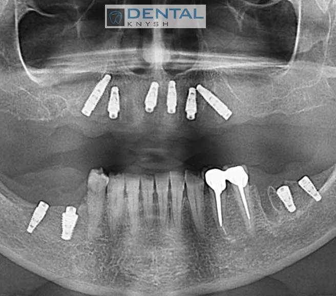 2023-09-09-скан-кт-10-імплантів-DentalKnysh