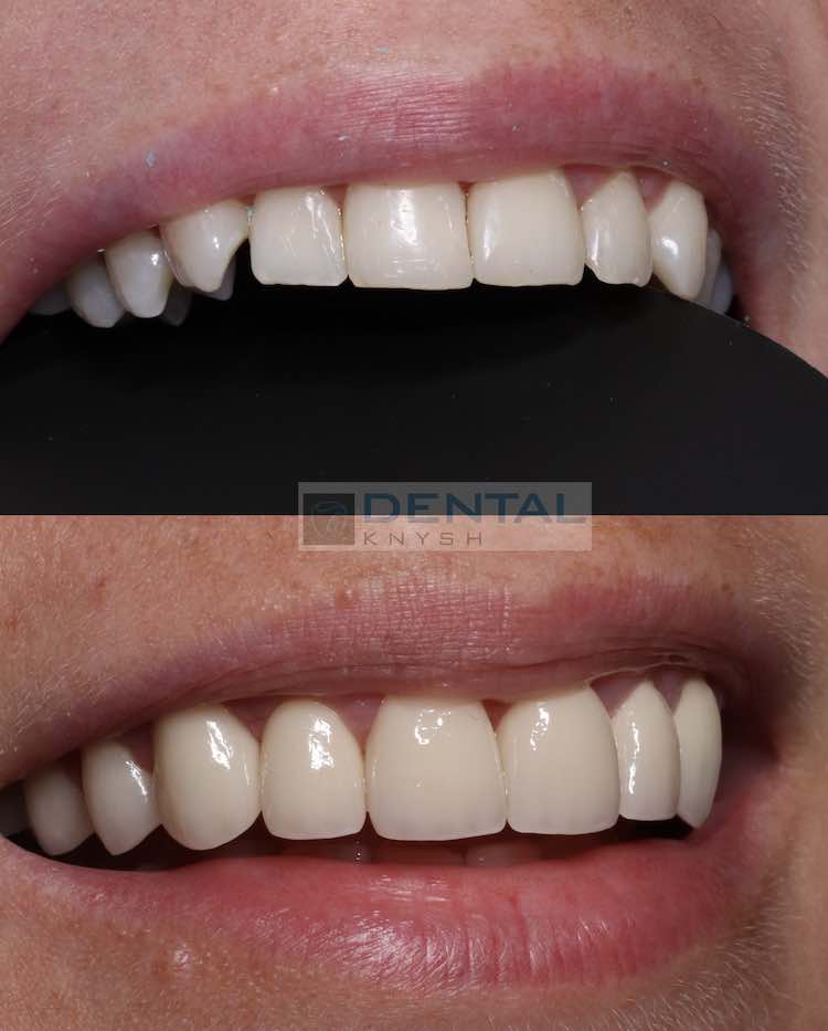 Керамічні вініри DentalKnysh фото звіт 2023-09-20 фото 3