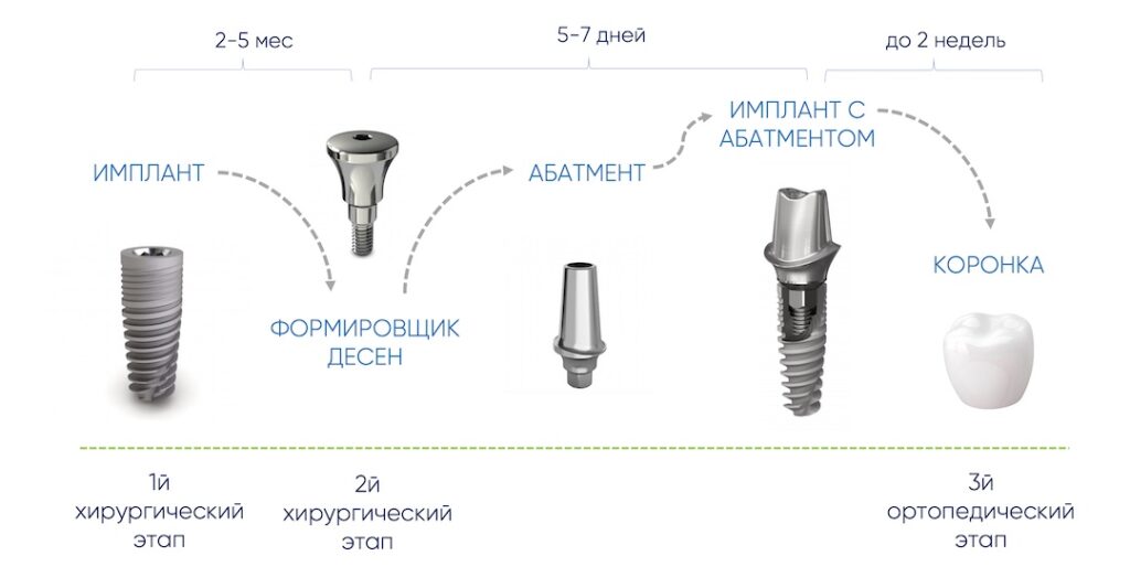 как ставится имплант зуба: этапы, сроки, фото элементов имплантации зубов