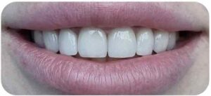 Відбілювання зубів Львів Акція