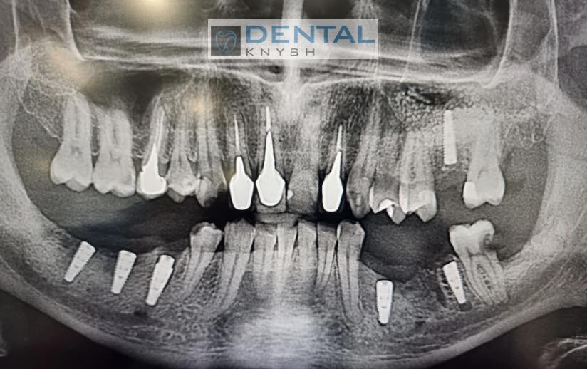 Фото звіт імплантація зубів, імплантів - 6 шт, DentalKnysh, KT, скан 3, 2023-08-31