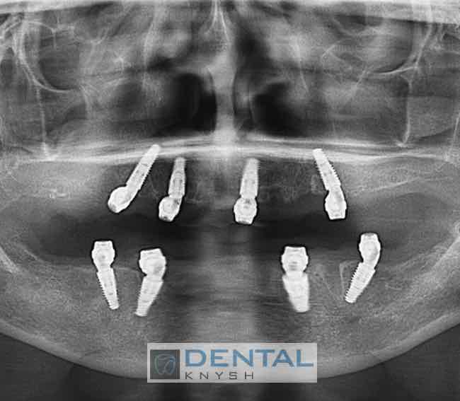 Фото звіт імплантація зубів, 2 х 4 імплантів, all-on-4, DentalKnysh, KT, скан 2, 2023-08-31