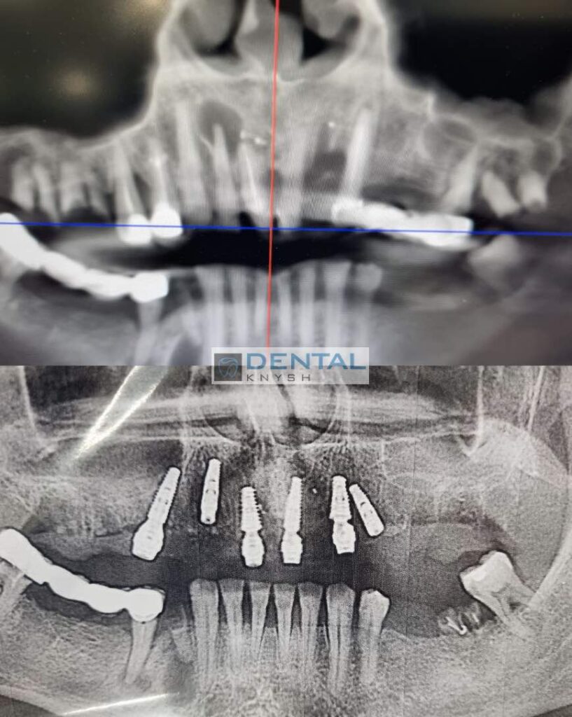 Синусліфтинг та імплантація зубів, 6 імплантів, all-on-6, DentalKnysh, KT скан 1, 2023-08-31