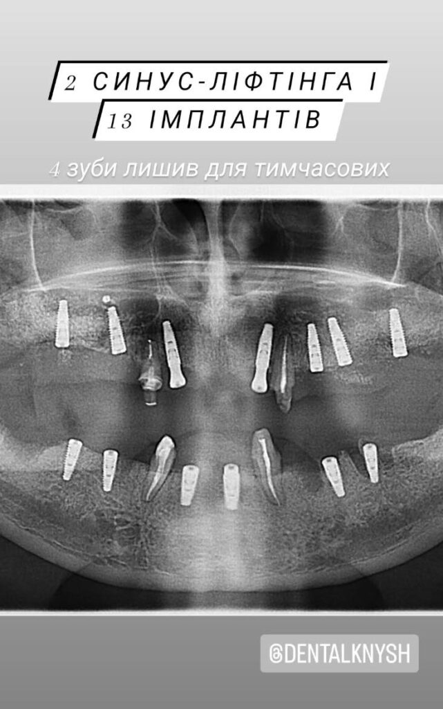Імплантація зубів в DentalKnysh 13 шт та 2 синусліфтинги 