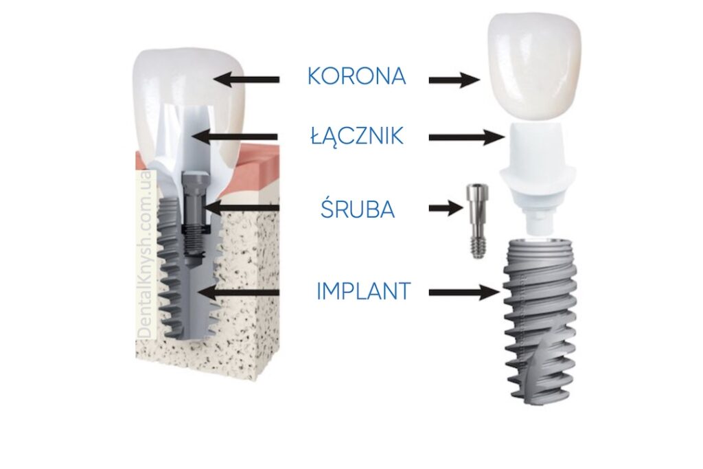 Cena implantu zęba: z czego się składa