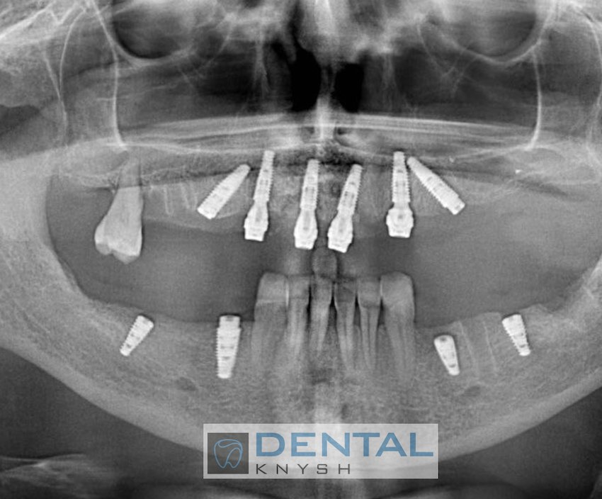 Фото звіт КТ імплантація в DentalKnysh 10 імплантів (2023-11-03)