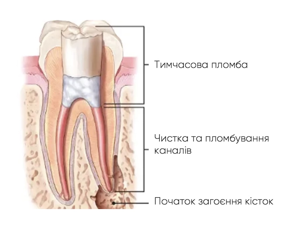 Чистка каналів зуба ціна Львів DentalKnysh