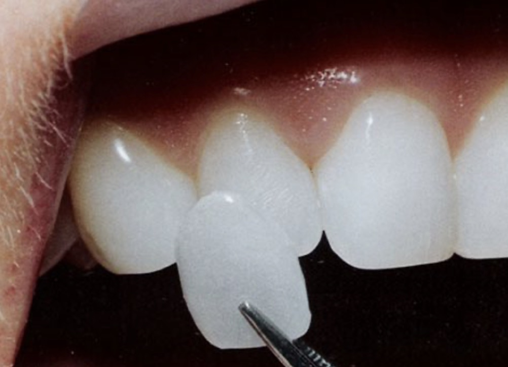 Преимущества и недостатки керамических виниров за и против