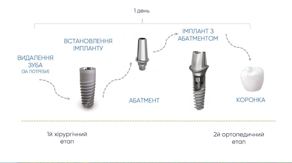 Одномоментна імплантація за та проти