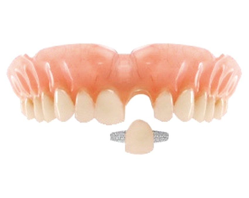 Сколько стоит вставить зуб: адгезивный мост