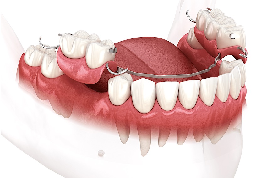 Сколько стоит вставить зуб: бюгельный протез