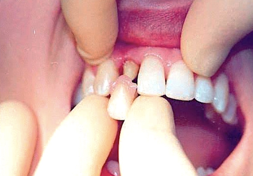 Сколько стоит вставить зуб: Коронка