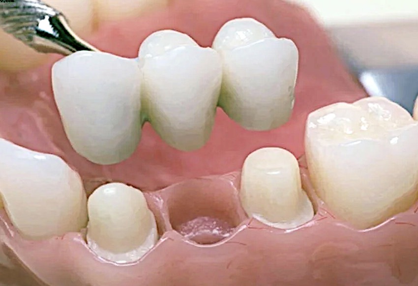 Сколько стоит вставить зуб: мостовидный протез