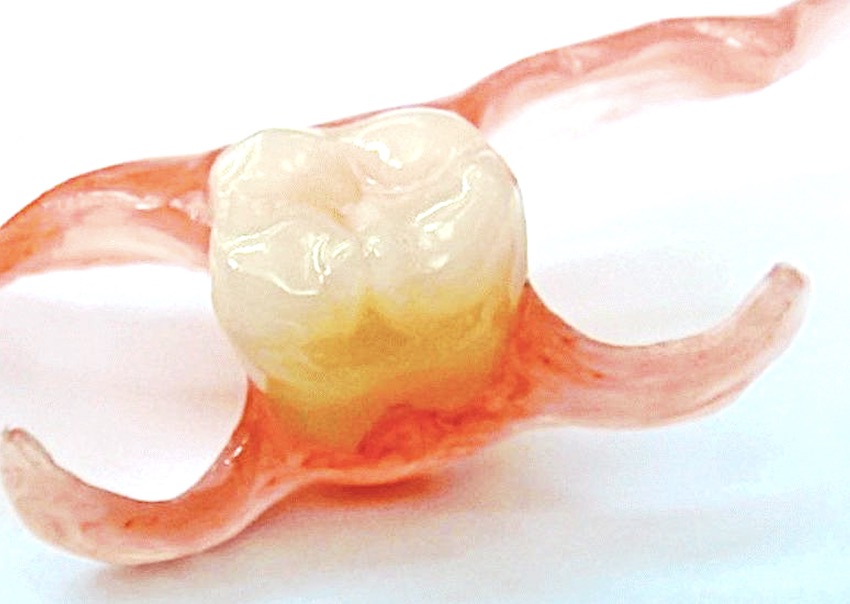 Сколько стоит вставить зуб: протез бабочка