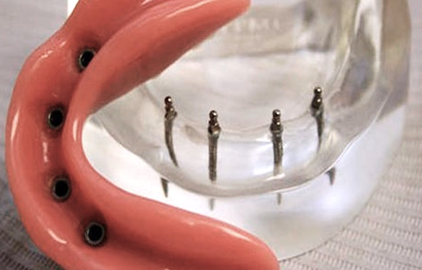 Сколько стоит вставить зуб: протез  на мини-имплантах