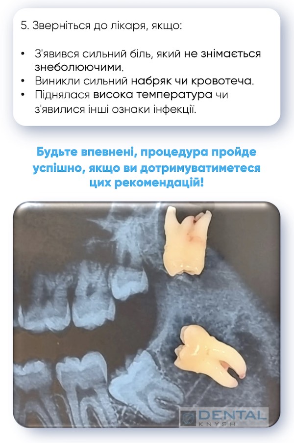 чек-лист підготовка до видалення зуба мудрості 8