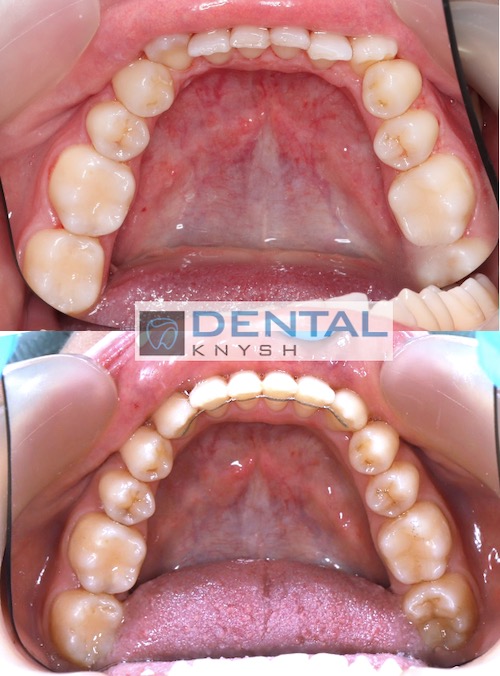 Результати лікування брекетами в DentalKnysh 2025-04-15 фото 1