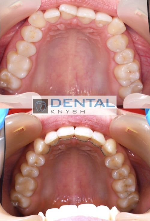 Результати лікування брекетами в DentalKnysh 2025-04-15 фото 2