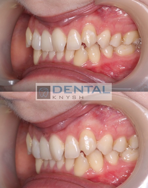 Результати лікування брекетами в DentalKnysh 2025-04-15 фото 3