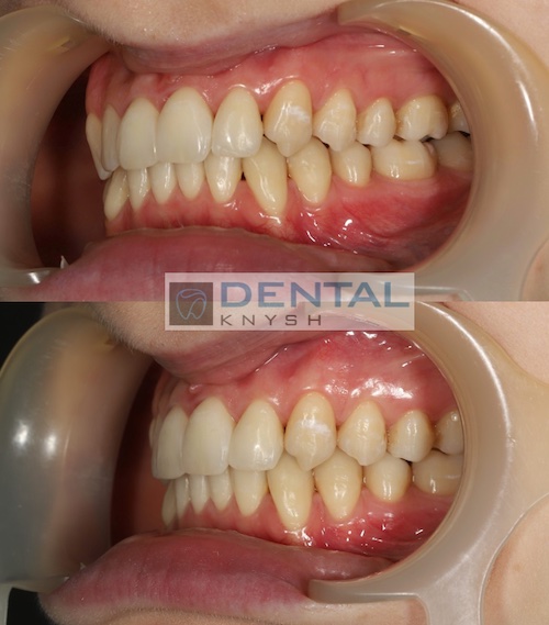 Результати лікування брекетами в DentalKnysh 2025-04-15 фото 4