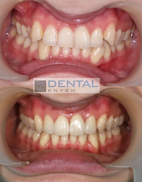 Результати лікування брекетами в DentalKnysh 2025-04-15 фото 5