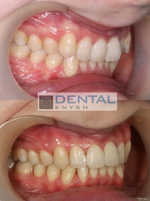 Результати лікування брекетами в DentalKnysh 2025-04-15 фото 6