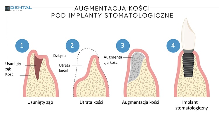 Procedura augmentacji kości pod implanty stomatologiczne