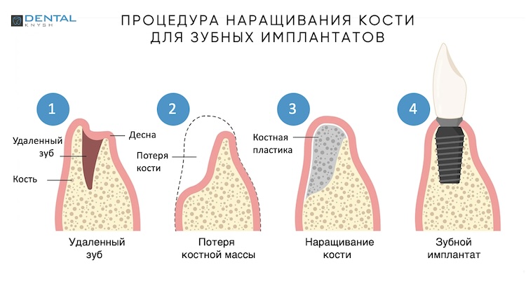 Процедура наращивания кости для зубных имплантов.