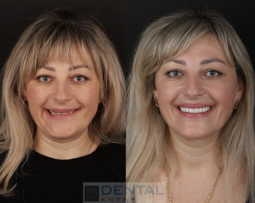 Фото звіт: імплантація одного зуба та керамічні вініри в DentalKnysh 2025-08-05