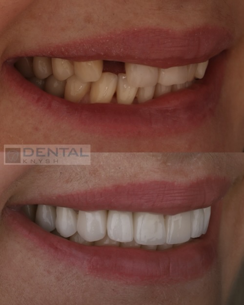 Фото звіт: імплантація одного зуба та керамічні вініри в DentalKnysh 2025-08-05 фото 2