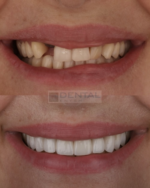 Фото звіт: імплантація одного зуба та керамічні вініри в DentalKnysh 2025-08-05 фото 1