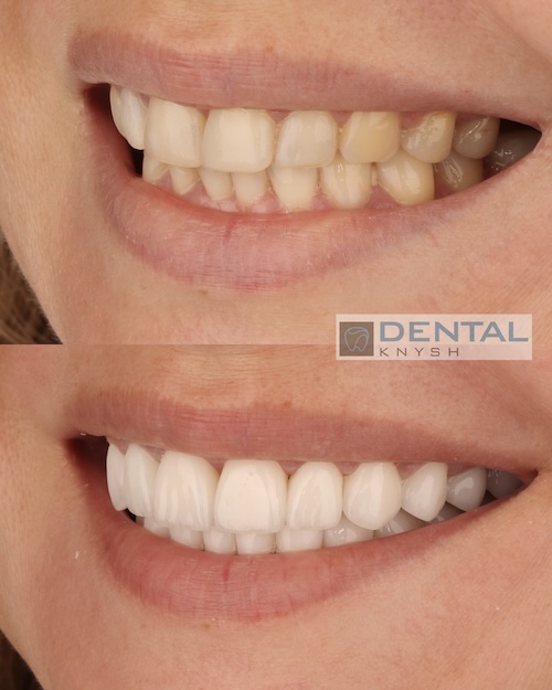 Fotorelacja: efekty licówek ceramicznych i implantów w DentalKnysh, 22.09.2025, zdjęcia 1