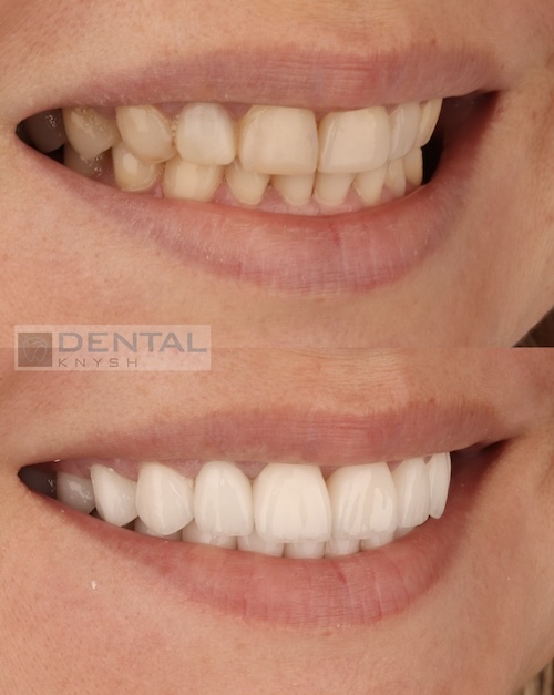 Fotorelacja: efekty licówek ceramicznych i implantów w DentalKnysh, 22.09.2025, zdjęcia 2
