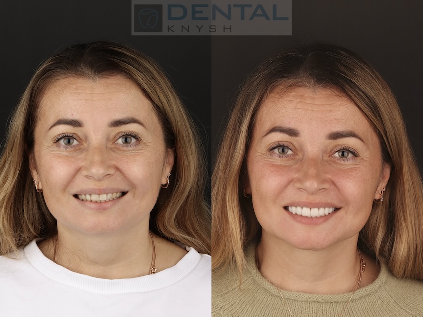 Fotorelacja: efekty licówek ceramicznych i implantów w DentalKnysh, 22.09.2025, zdjęcia przed/po