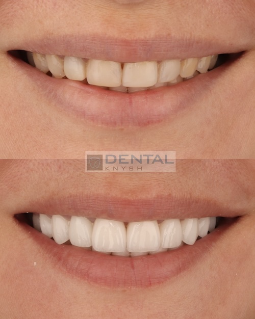 Fotorelacja: efekty licówek ceramicznych i implantów w DentalKnysh, 22.09.2025