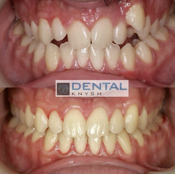 Fotorelacja: efekty leczenia w gabinecie DentalKnysh, aparaty ortodontyczne na zęby, lek. Waleria Bonar, 2025-10-21 zdjęcie 1