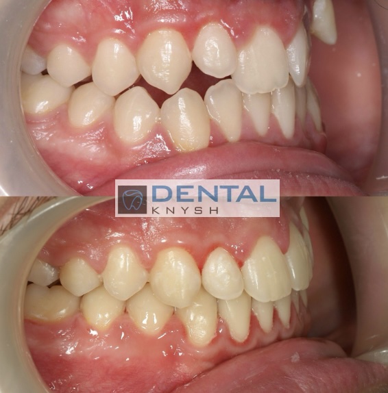 Fotorelacja: efekty leczenia w gabinecie DentalKnysh, aparaty ortodontyczne na zęby, lek. Waleria Bonar, 2025-10-21 zdjęcie 2