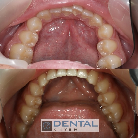 Fotorelacja: efekty leczenia w gabinecie DentalKnysh, aparaty ortodontyczne na zęby, lek. Waleria Bonar, 2025-10-21 zdjęcie 3